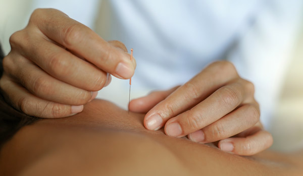 Practitioner inserting a fine needle into a muscle